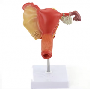 Female internal and external genital lesions Uterine model 2 parts