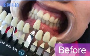 soyuq işıq ağardıcı alət sütun sıxacındakı LED mavi kart masa ağardıcı lampa kosmetik diş gözəllik aləti