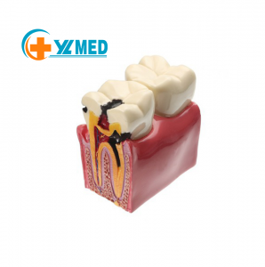 Dental Caries Teeth Model – Anatomy Education Model Caries Bilateral Comparison Study Model 6 Times Cross-Section Demonstration Model Tooth Decay Props for Science Teaching