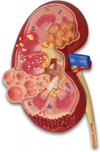 Anatomy urology special renal lesion model human kidney anatomy model