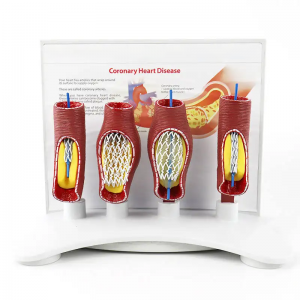 Medische wetenschap vasculair stentmodel Menselijk vasculair model Medisch menselijk onderwijs pathologisch vasculair anatomiemodel